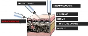 Injection Intradermique